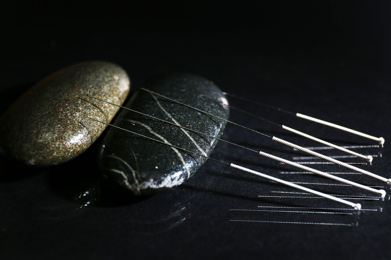 Wondering Does Acupuncture Hurt? NYSRAweb